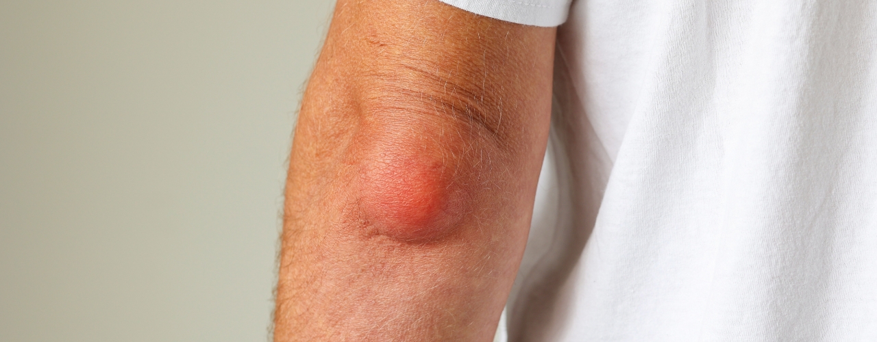 Physical-therapy-clinic-bursitis-Haymarket-PT-Gainesville-Bealeton-Bristow-VA