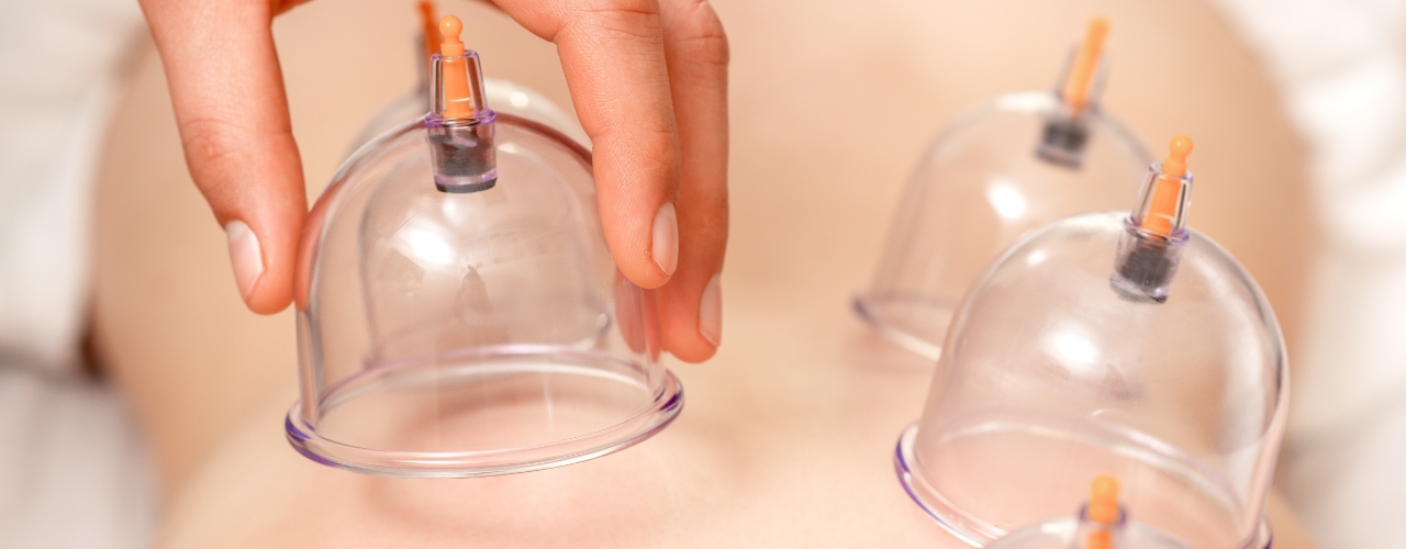 physical-therapy-clinic-cupping-Haymarket-PT-Gainesville-Bealeton-Bristow-VA