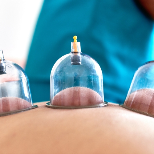 physical-therapy-clinic-cupping-Haymarket-PT-Gainesville-Bealeton-Bristow-VA