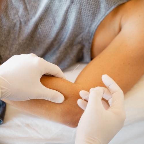 physical-therapy-clinic-dry-needling-Haymarket-PT-Gainesville-Bealeton-Bristow-VA