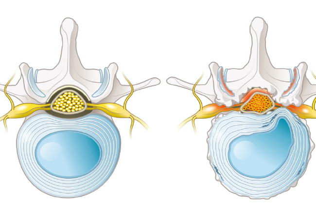 Real Solutions for Back Pain Caused by Herniated Discs